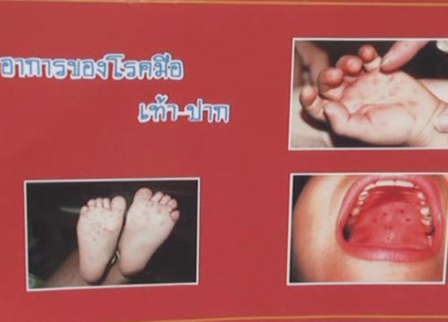 โรคมือเท้าปาก
