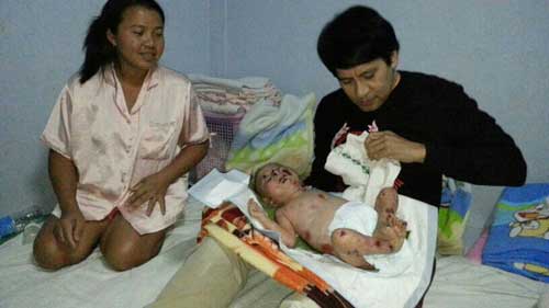 น้องเคน ป่วยโรคน้ำเหลืองใส