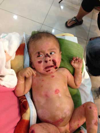 น้องเคน ป่วยโรคน้ำเหลืองใส