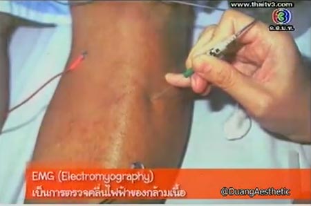 EMG การตรวจคลื่นไฟฟ้าของกล้ามเนื้อ EMG การตรวจคลื่นไฟฟ้าของกล้ามเนื้อ