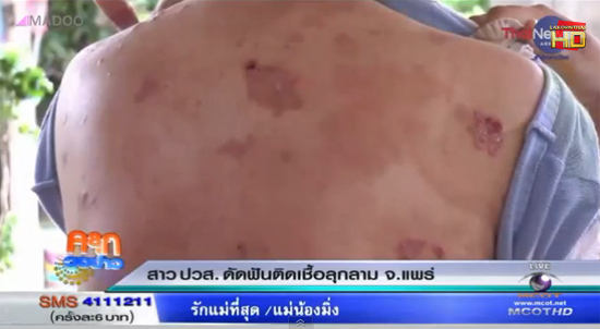 สาวป่วยโรคตุ่มน้ำพอง เจอ 1 ในล้าน คาดติดเชื้อจากจัดฟัน สาวป่วยโรคตุ่มน้ำพอง เจอ 1 ในล้าน คาดติดเชื้อจากจัดฟัน
