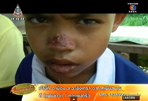 แม่วอนช่วยลูกชายป่วยแปลก เป็นโรคผิวหนังนาน 7 ปี รักษาไม่หาย แม่วอนช่วยลูกชายป่วยแปลก เป็นโรคผิวหนังนาน 7 ปี รักษาไม่หาย