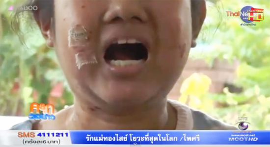 สาวป่วยโรคตุ่มน้ำพอง เจอ 1 ในล้าน คาดติดเชื้อจากจัดฟัน สาวป่วยโรคตุ่มน้ำพอง เจอ 1 ในล้าน คาดติดเชื้อจากจัดฟัน