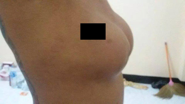 ศัลยกรรมเสริมหน้าอกราคาถูก ทำสาวนมเน่า จุกเคลื่อน ศัลยกรรมเสริมหน้าอกราคาถูก ทำสาวนมเน่า จุกเคลื่อน