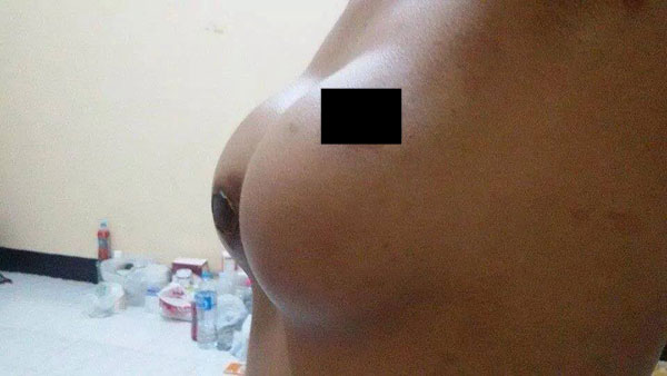 ศัลยกรรมเสริมหน้าอกราคาถูก ทำสาวนมเน่า จุกเคลื่อน ศัลยกรรมเสริมหน้าอกราคาถูก ทำสาวนมเน่า จุกเคลื่อน