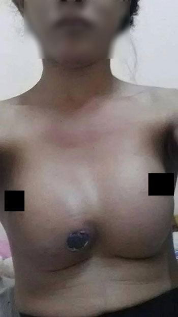 ศัลยกรรมเสริมหน้าอกราคาถูก ทำสาวนมเน่า จุกเคลื่อน ศัลยกรรมเสริมหน้าอกราคาถูก ทำสาวนมเน่า จุกเคลื่อน