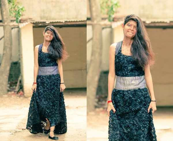 อินเดียถ่ายแฟชั่นหญิงถูกสาดน้ำกรด อินเดียถ่ายแฟชั่นหญิงถูกสาดน้ำกรด