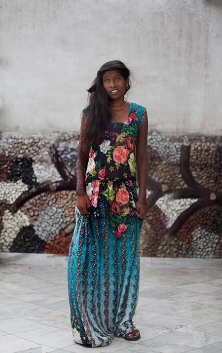 อินเดียถ่ายแฟชั่นหญิงถูกสาดน้ำกรด อินเดียถ่ายแฟชั่นหญิงถูกสาดน้ำกรด