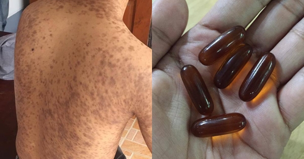 กินกลูต้าไธโอนหวังขาว แต่ผิวพัง เกิดปื้นคล้ายปานดำเต็มตัว กินกลูต้าไธโอนหวังขาว แต่ผิวพัง เกิดปื้นคล้ายปานดำเต็มตัว