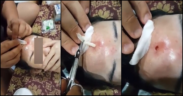 สยอง !! สาวฉีดฟิลเลอร์จนอักเสบ หน้าผากทะลุเป็นรูเห็นถึงกะโหลก สยอง !! สาวฉีดฟิลเลอร์จนอักเสบ หน้าผากทะลุเป็นรูเห็นถึงกะโหลก