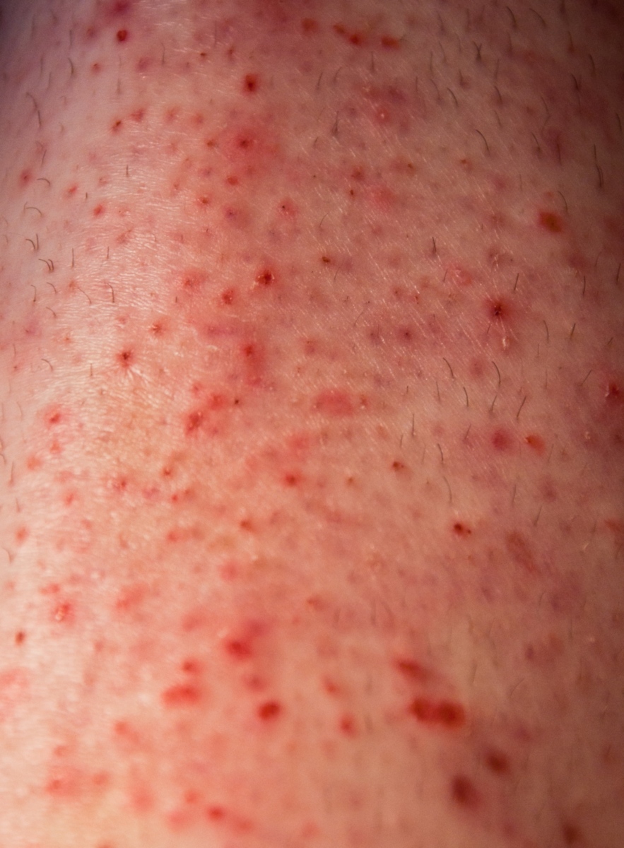 โรคเดอร์มาทิลโลมาเนีย (dermatillomania) โรคเดอร์มาทิลโลมาเนีย (dermatillomania)