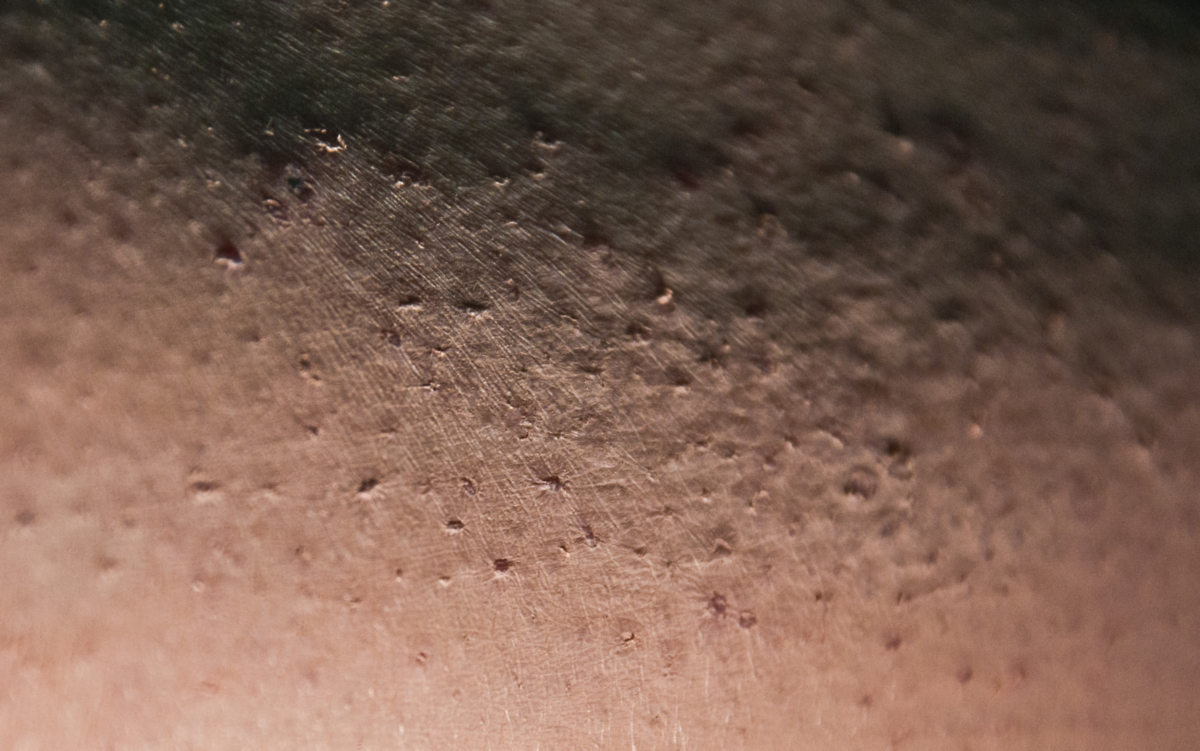 โรคเดอร์มาทิลโลมาเนีย (dermatillomania) โรคเดอร์มาทิลโลมาเนีย (dermatillomania)