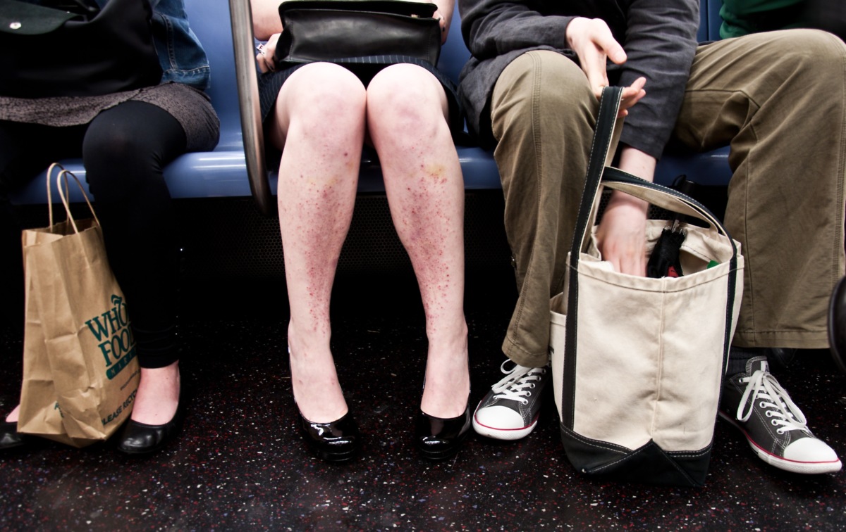 โรคเดอร์มาทิลโลมาเนีย (dermatillomania) โรคเดอร์มาทิลโลมาเนีย (dermatillomania)