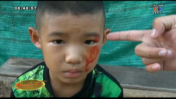 น้องเติ้ล เด็กป่วยโรคเหงื่อออกเป็นเลือด น้องเติ้ล เด็กป่วยโรคเหงื่อออกเป็นเลือด