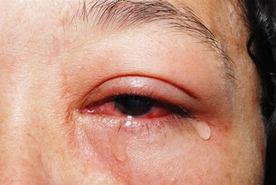 โรคตาแดง โรคตาแดง