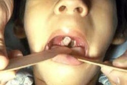 โรคคอตีบ