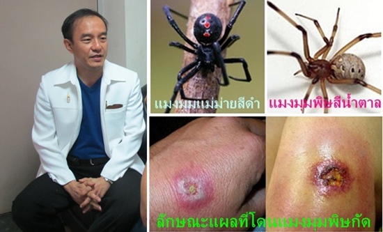 แมงมุมพิษกัด แมงมุมพิษกัด