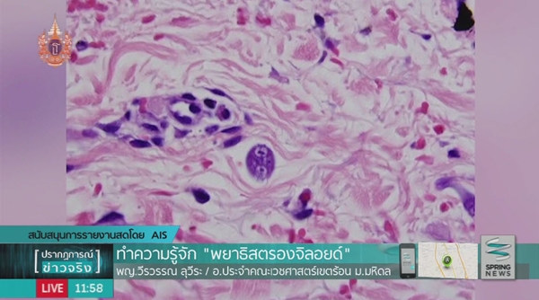 พยาธิสตรองจิลอยด์ พยาธิสตรองจิลอยด์