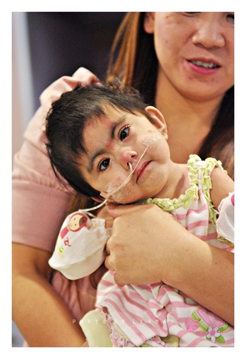 น้องโมเน่ต์ หนูน้อยแขนพิการ 2 ข้าง