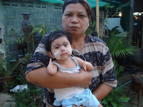 น้องโมเน่ต์ หนูน้อยแขนพิการ 2 ข้าง