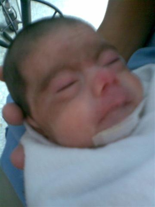 น้องโมเน่ต์ หนูน้อยแขนพิการ 2 ข้าง