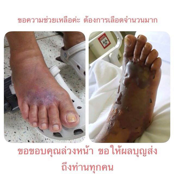 แบคทีเรียกินเนื้อคน แบคทีเรียกินเนื้อคน
