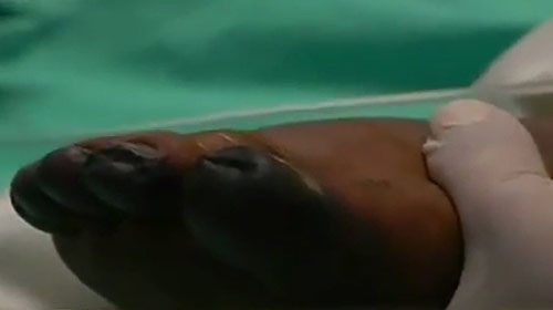 แมงมุมพิษกัดขาหนุ่มเมืองแพร่ อาจถึงขั้นตัดขาทิ้ง แมงมุมพิษกัดขาหนุ่มเมืองแพร่ อาจถึงขั้นตัดขาทิ้ง