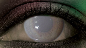 คอนแทคเลนส์ผี คอนแทคเลนส์ผี