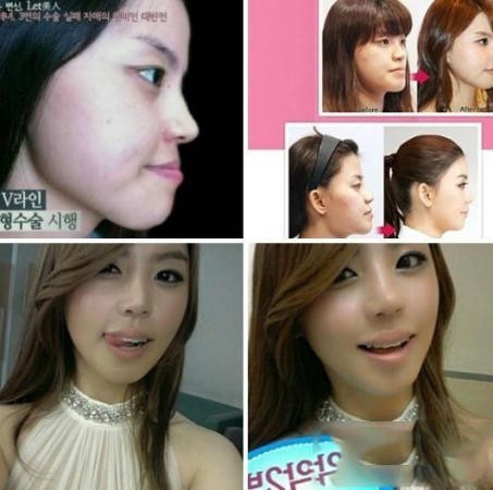 ศัลยกรรมเกาหลี ศัลยกรรมเกาหลี