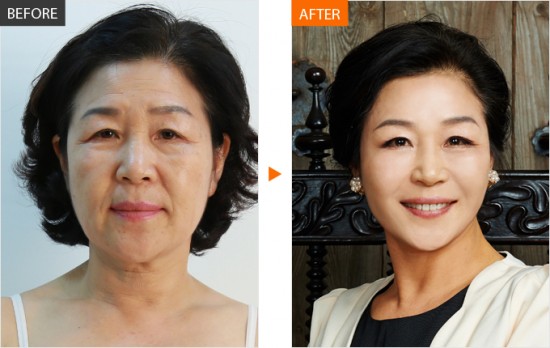 ศัลยกรรมเกาหลี ศัลยกรรมเกาหลี