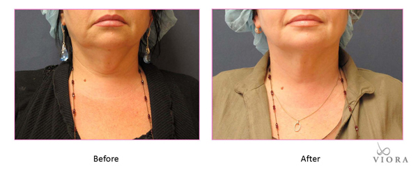 การดูดผิว การดูดผิว