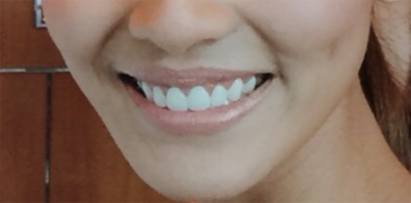 ตัดเหงือก ตัดเหงือก