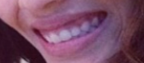 ตัดเหงือก ตัดเหงือก