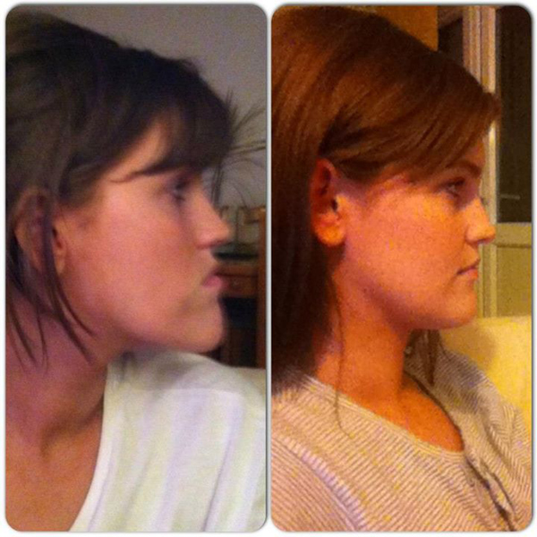 ศัลยกรรมกราม ศัลยกรรมกราม