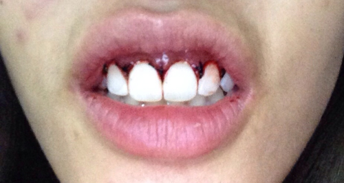 ตัดเหงือก ตัดเหงือก