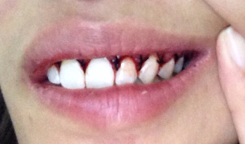 ตัดเหงือก ตัดเหงือก