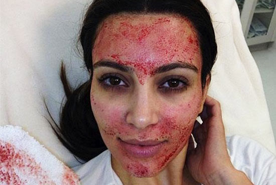 ฟิลเลอร์เลือด ฟิลเลอร์เลือด