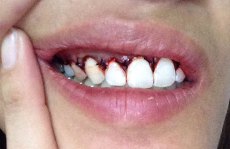 ตัดเหงือก ตัดเหงือก