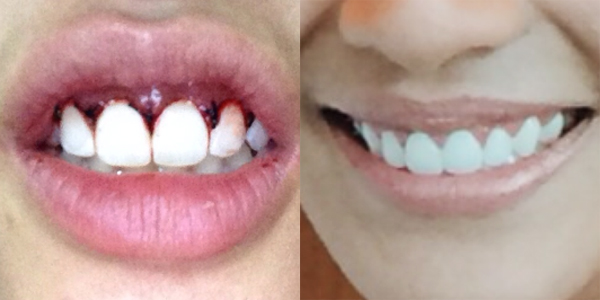 ตัดเหงือก ตัดเหงือก