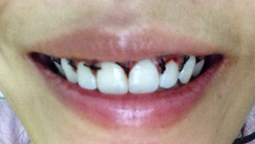 ตัดเหงือก ตัดเหงือก