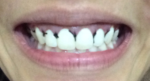 ตัดเหงือก ตัดเหงือก