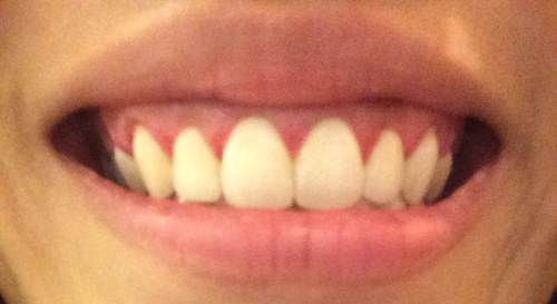 ตัดเหงือก ตัดเหงือก