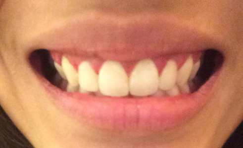 ตัดเหงือก ตัดเหงือก