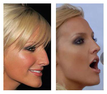 ดาราฮอลลีวูดศัลยกรรม ดาราฮอลลีวูดศัลยกรรม