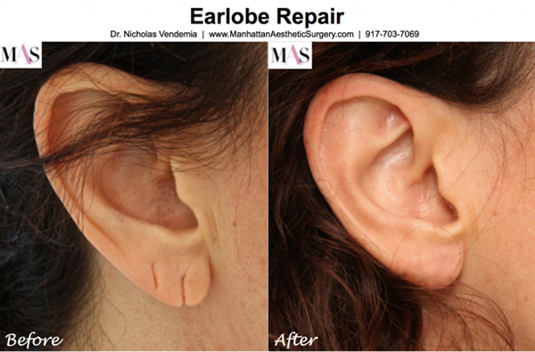 ศัลยกรรมติ่งหู ศัลยกรรมติ่งหู