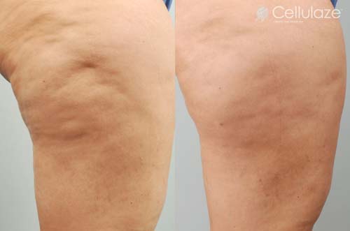 วิธีกำจัดเซลลูไลท์