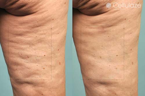 วิธีกำจัดเซลลูไลท์