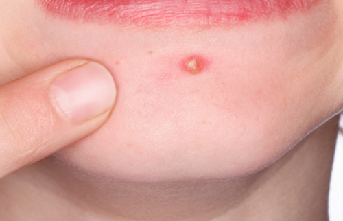 วิธีเสริมหล่อ วิธีเสริมหล่อ