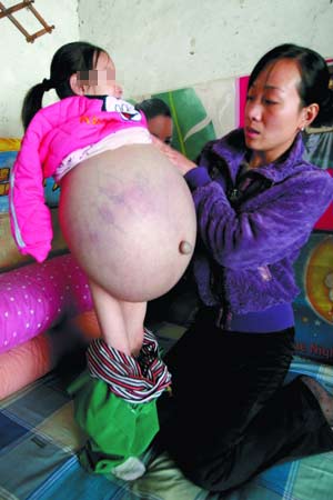  หนูน้อยจีน 4 ขวบป่วยท้องโต หมอเร่งช่วย