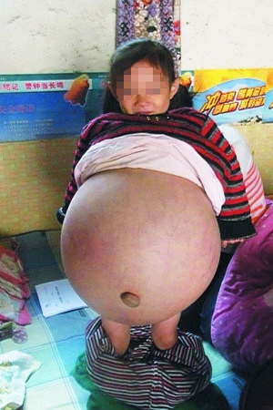 โรคประหลาด